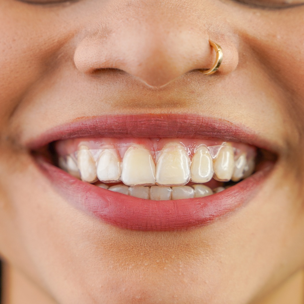Junge Frau aus Indien, die eine herausnehmbare, unsichtbare Zahnspange in der Hand hält, auch bekannt als „Invisalign“ oder „Clear Aligner“