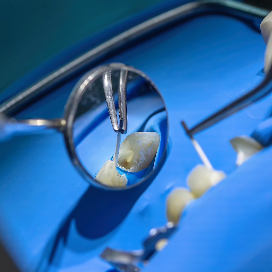 Nahaufnahme einer Wurzelkanalbehandlung unter Kofferdam-Isolierung. Ein Zahnarzt reinigt und präpariert den infizierten Kanal mit endodontischen Instrumenten in einer modernen Zahnarztpraxis.