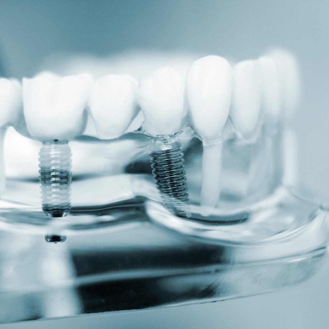 Zahnärzte, Zahnmedizin, Zähne, Implantat